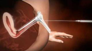 3D animation of how IUI works [upl. by Caia]