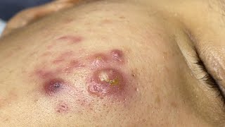 Satisfying With Loan Nguyen Spa Video 064 acnetreatment [upl. by Larsen]