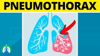 Pneumothorax Medical Definition  Quick Explainer Video [upl. by Palila533]