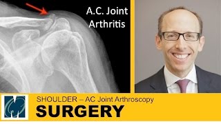 Acromioclavicular Arthritis [upl. by Shull]