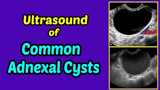 Management of RadiationInduced Hemorrhagic Cystitis [upl. by Sholem]