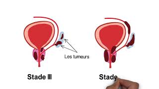 Comprendre le cancer de la prostate [upl. by Nollat]