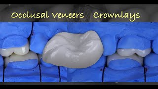 Table Top Prostheses for the Posterior Dentition with Video Demonstration [upl. by Chane]